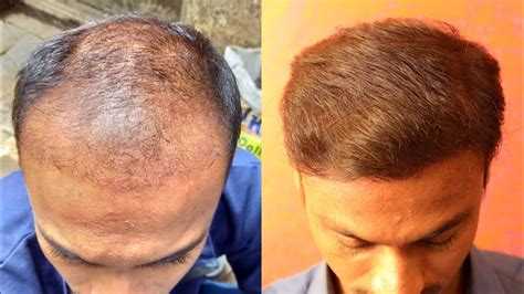 hair transplant best in india