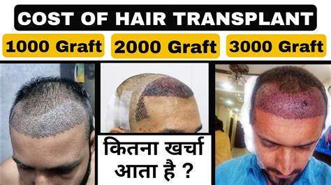 The Hair Transplant Cost In India Per Graft For Long Hair