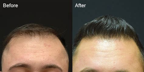 hair transplant cost new jersey