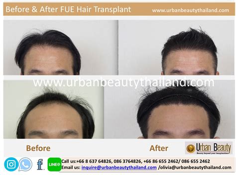 hair transplant cost thailand