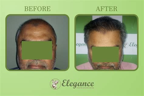 hair transplant gujarat india