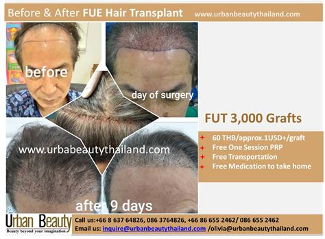 hair transplant in bangkok thailand