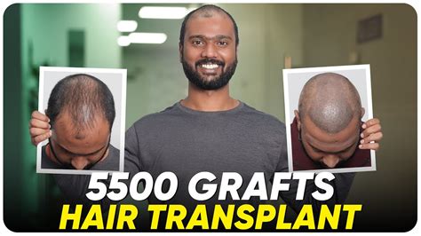 hair transplant in jamshedpur