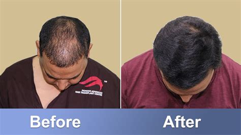 hair transplant in kochi