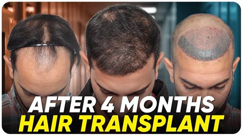hair transplant in nashik