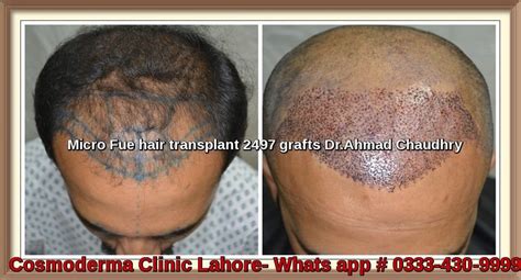 hair transplant in sialkot