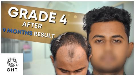 Hair Transplant In Kolkata কলকাতায় হেয়ার ট্রান্সপ্ল্যান্ট YouTube