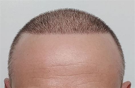 hair transplant los angeles