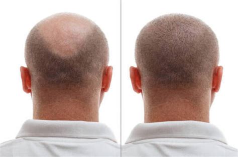 Hair Transplant in Qatar, Best Hair Transplant Clinic in Qatar