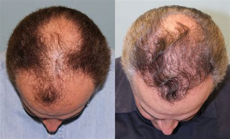 hair transplant reviews by patients
