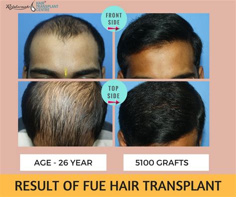  79 Popular Hair Transplant Turkey Age Limit For Short Hair