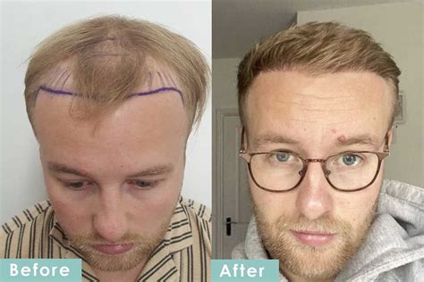 UK man warns others after £1,200 hair transplant left him badly scarred