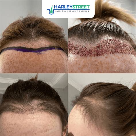 hair transplant uk harley street