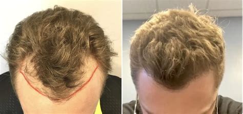 Hair Growth after Hair Transplant After Follicular Transfer FUE Hair