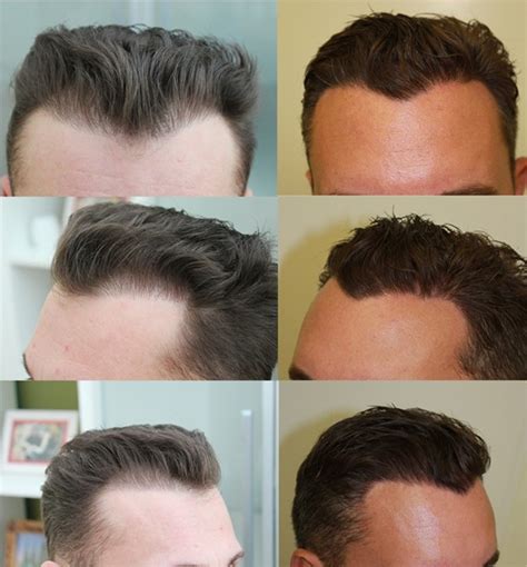 Top clinic in Zurich with top treatments in Hair transplant