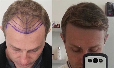 Hair Transplant Turkey from £1199 Free Consultation in UK GetHair