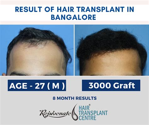 hair transplantation cost in bangalore