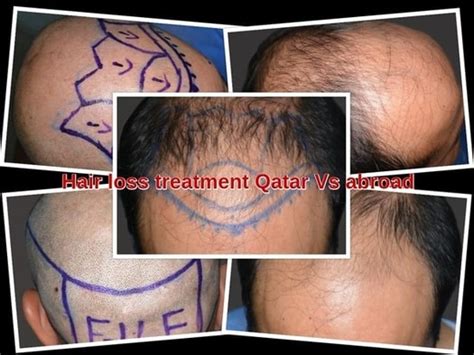 hair treatment in qatar