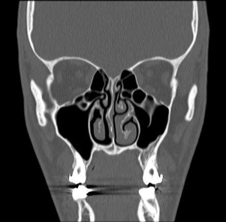 haller cells ct