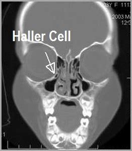 haller cells sinus treatment