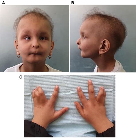 hallermann-streiff syndrome pictures