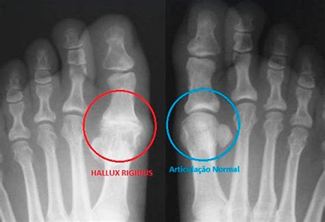 Hallux Rigidus
