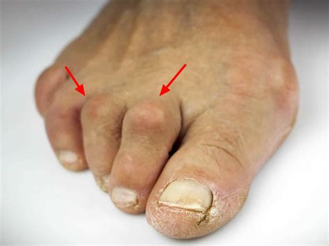 hammer toe causes and symptoms
