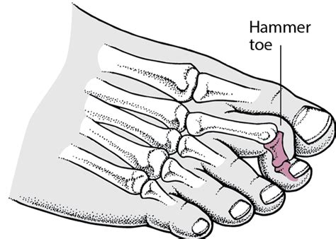 Hammer Toe Joint