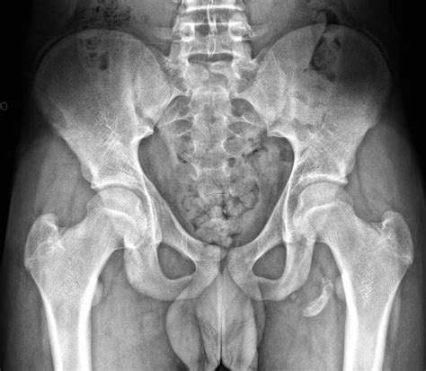 Hamstring Injury X Ray