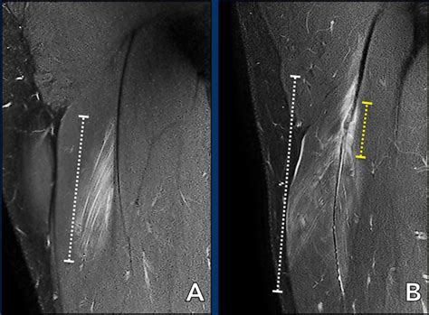 Hamstring Strain Xray
