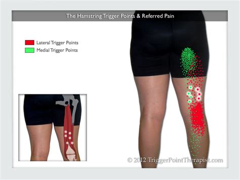 Hamstring Trigger Points