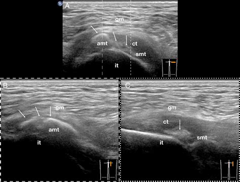 Hamstring Ultrasound Injection