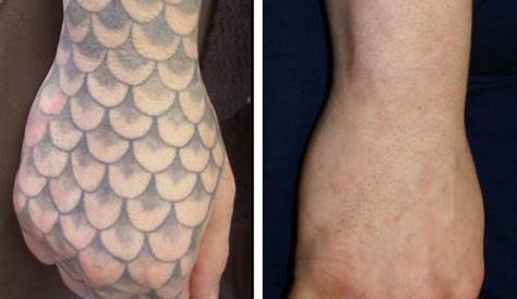 Hand Tattoo Removal Before And After Laser Best Ideas
