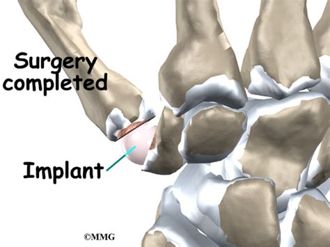 Hand Surgery Thumb Joint Replacement