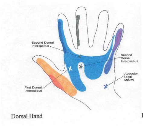 Hand Trigger Points Chart