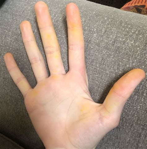 Hands Are Yellowish