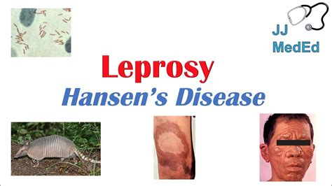 hansen's disease name origin