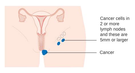 Understanding a Hard Lump Inside Vulva: Causes, Symptoms, and Treatment Options