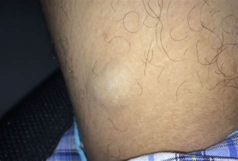 hard lump on inside of thigh