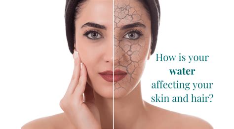 Hard Water Skin Problems