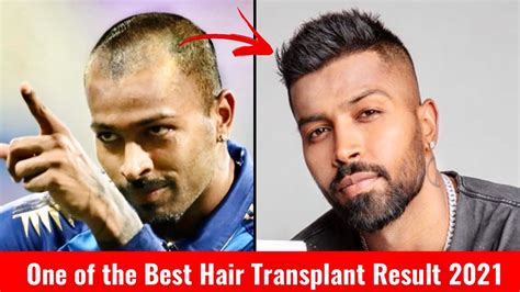 hardik pandya hair transplant