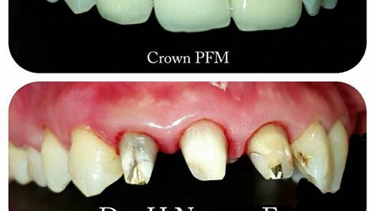 Dental Crown (Jaket Gigi) E Dental