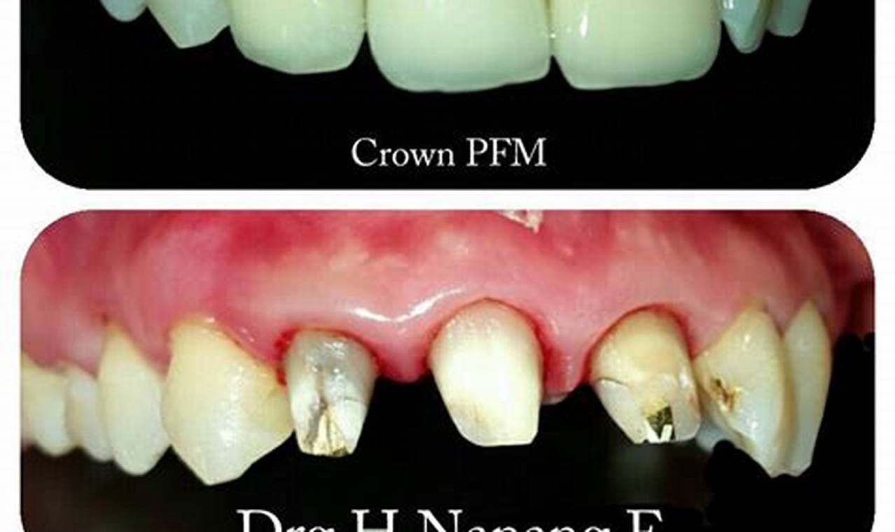 Dental Crown (Jaket Gigi) E Dental