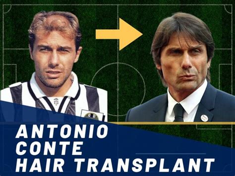 has antonio conte had a hair transplant