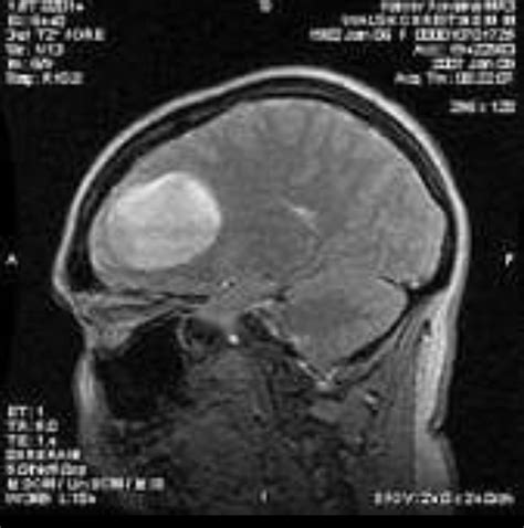 has anyone beat stage 4 glioblastoma