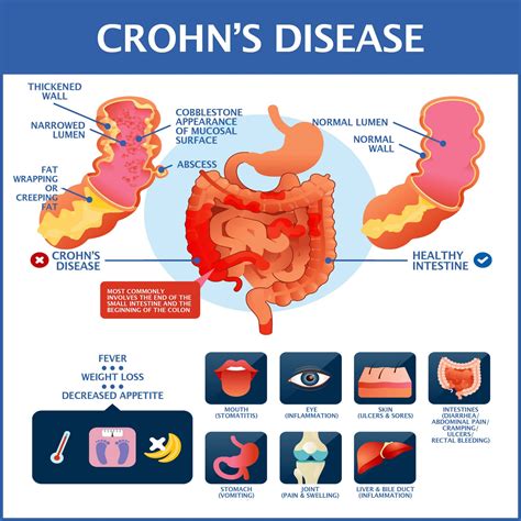 has maladie de crohn