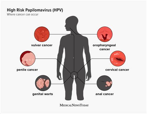 having high risk hpv