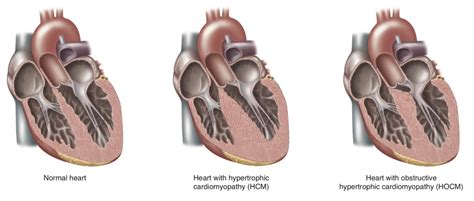 hcm medical abbreviation heart