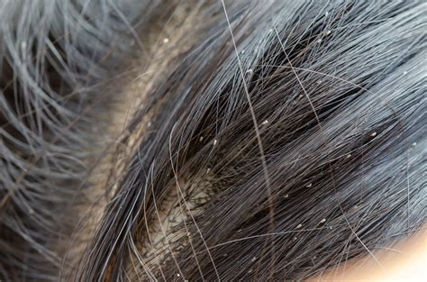 Head Lice Common