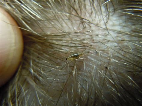 Head Lice Live On Clothes